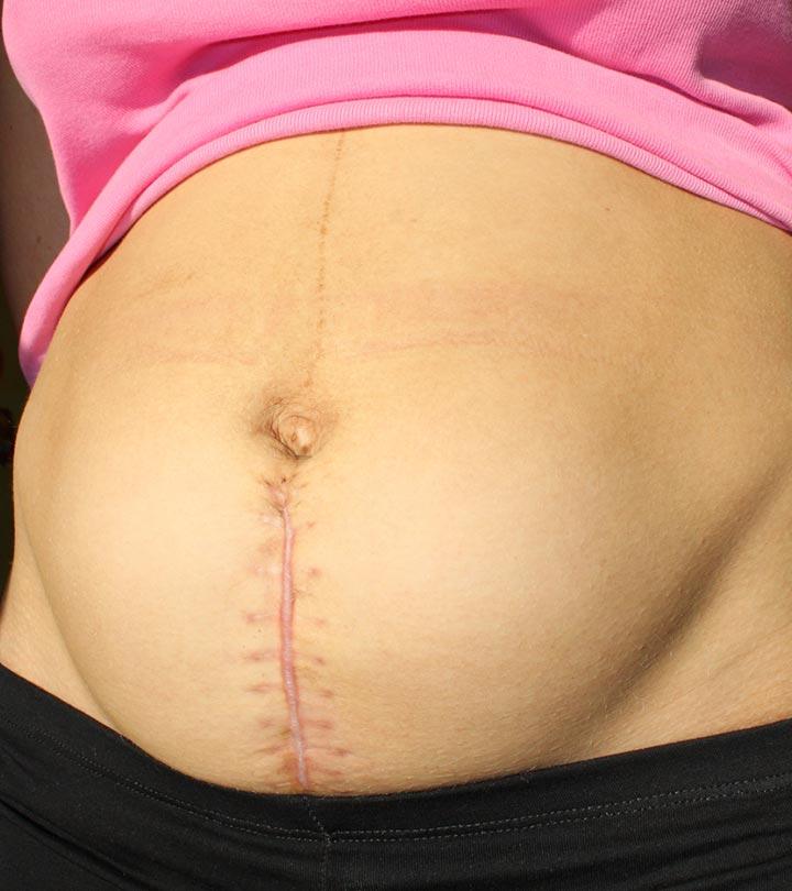 Woman With C Section Scar