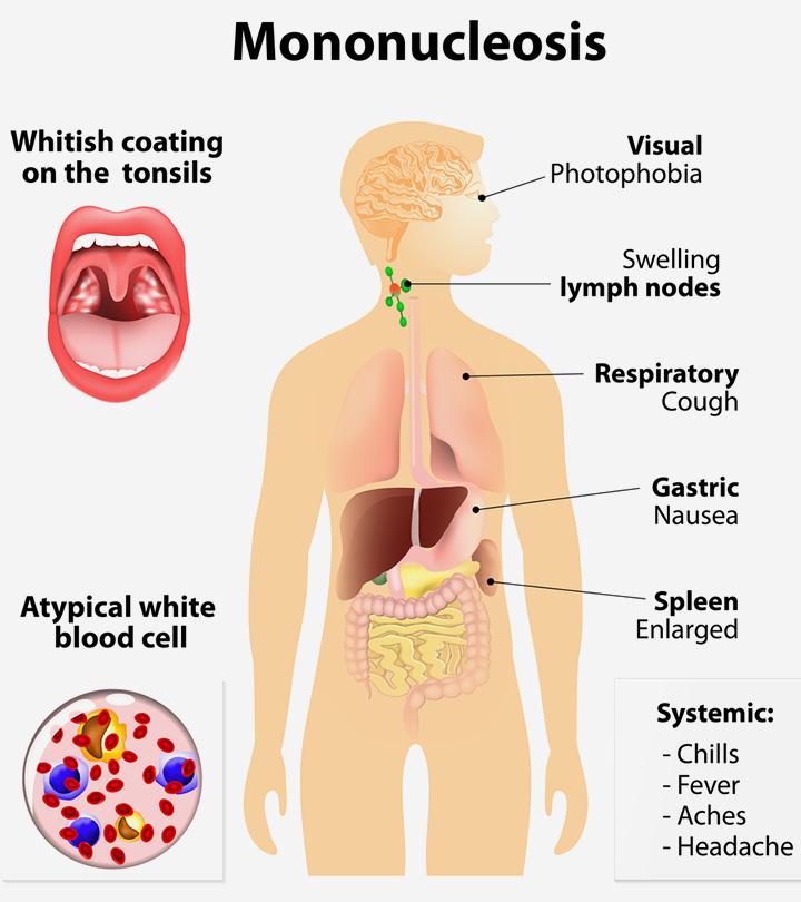 Mononucleosis Infection  Causes of Mono & Common Questions