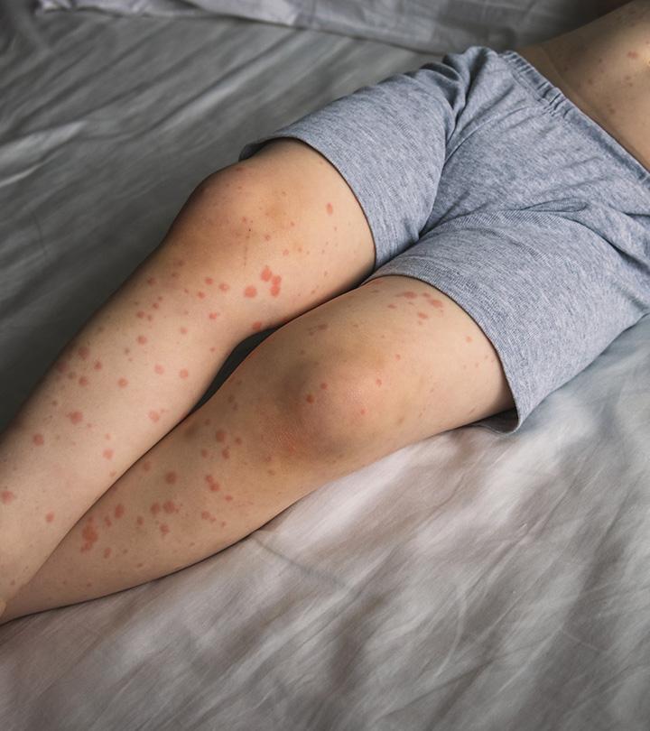 A Kid Suffering From Roseola