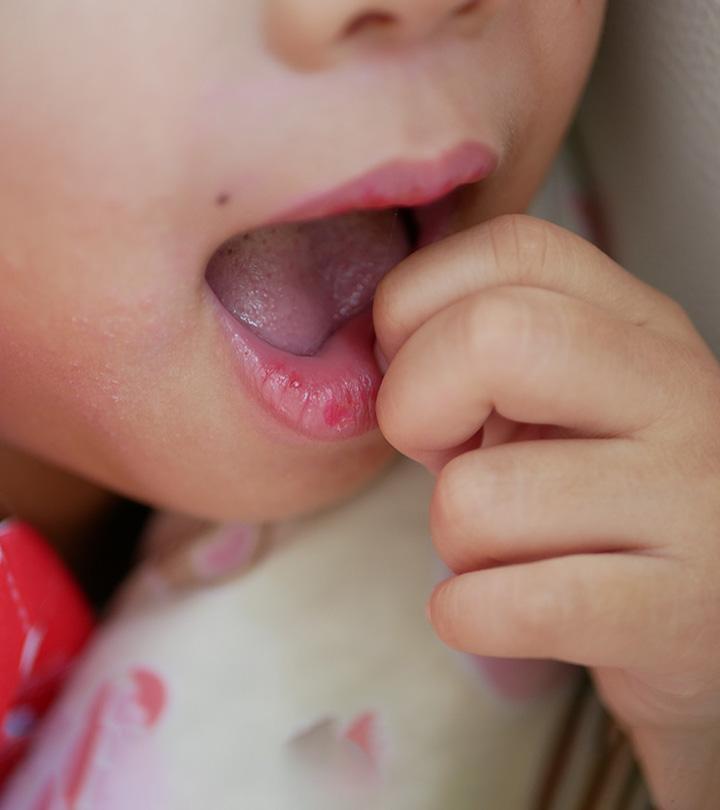 Signs Of Skin Picking In Children
