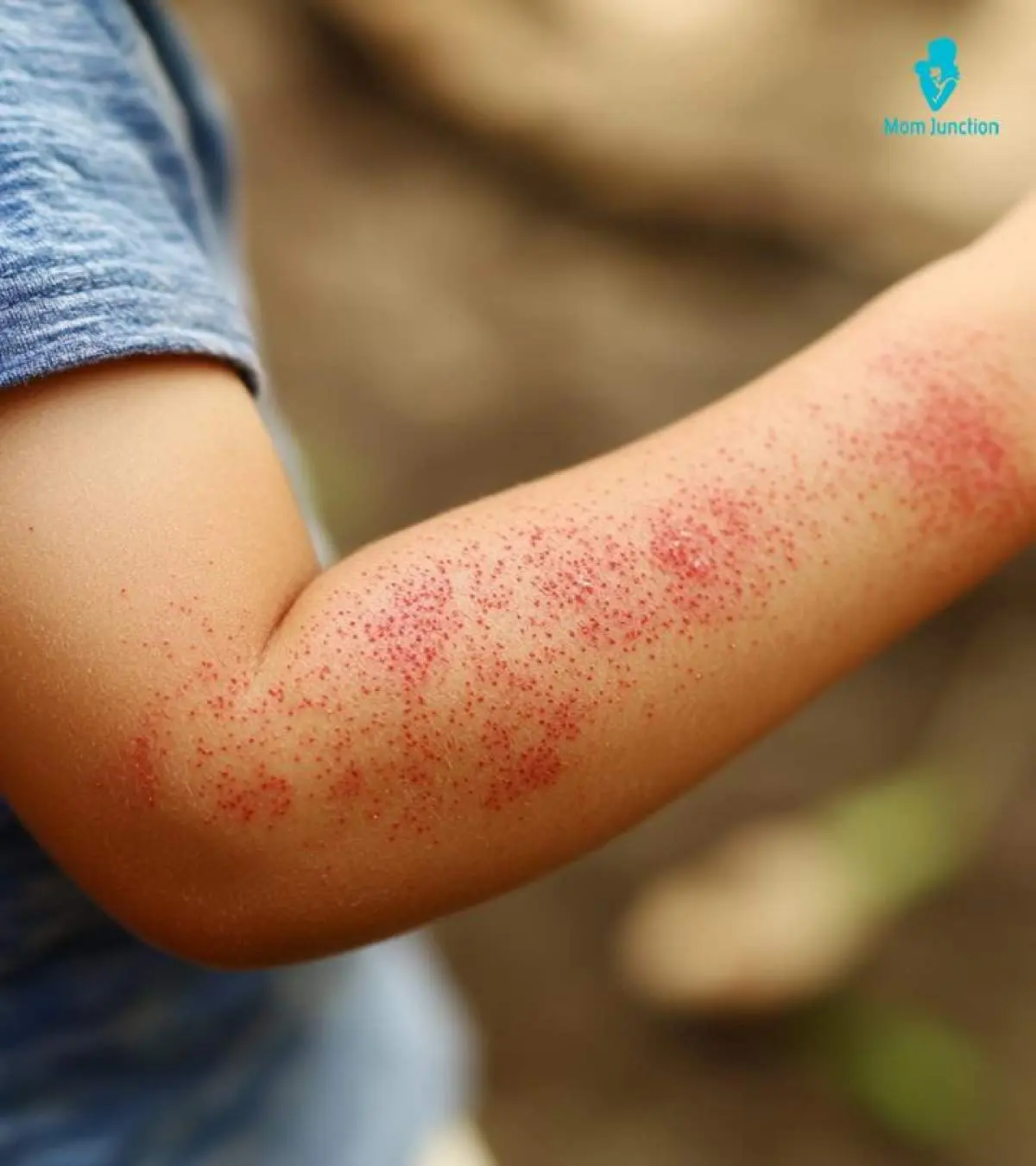 pediatric rash picture 