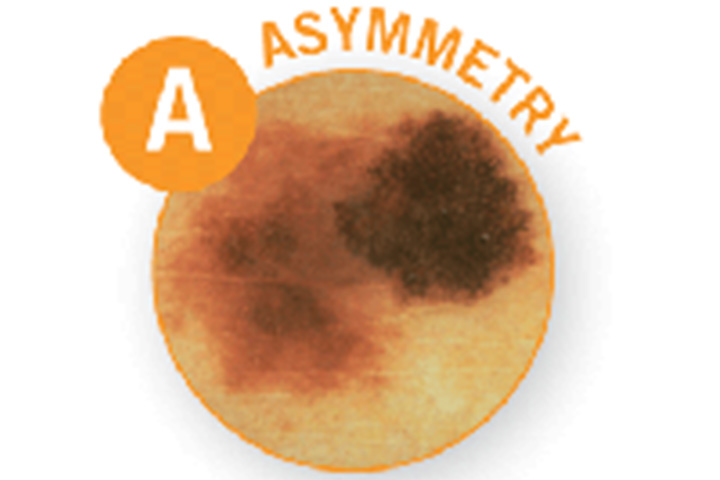 A - Asymmetry, melanoma in children