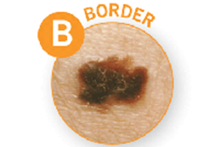 B - Border, melanoma in children