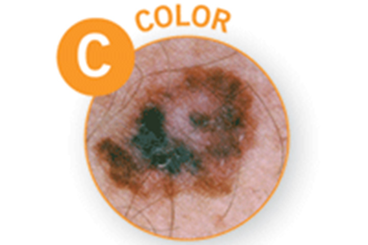 C - Color, melanoma in children