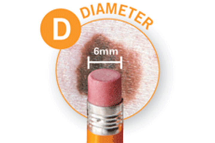 D - Diameter, melanoma in children