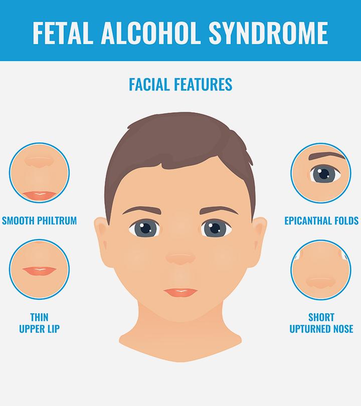 Fetal Alcohol Syndrome During Pregnancy