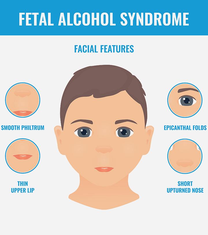 Fetal Alcohol Syndrome (FAS): Causes, Symptoms And Treatment