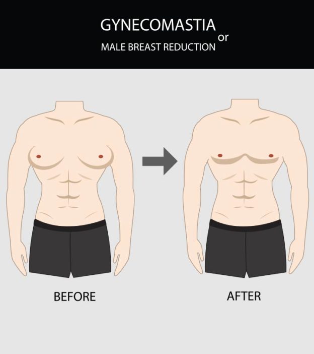 Gynecomastia In Teens: Causes, Signs, Diagnosis & Treatment