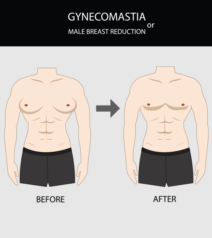 Teens before and after photos while taking gynecomastia