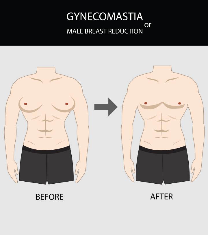 Gynecomastia In Teens: Causes, Signs, Diagnosis & Treatment