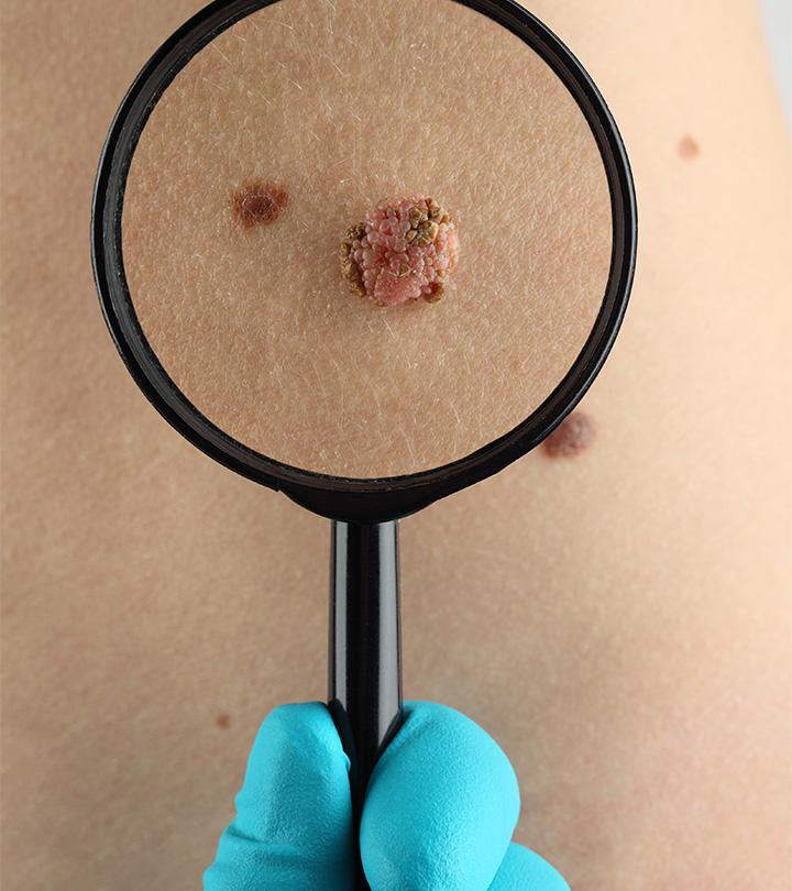 Melanoma In Children: Symptoms, Diagnosis And Treatment