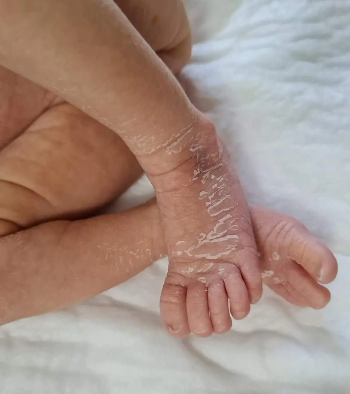Newborn skin peeling discount