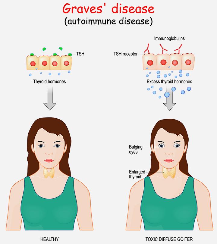Representation Of Graves Disease In Children