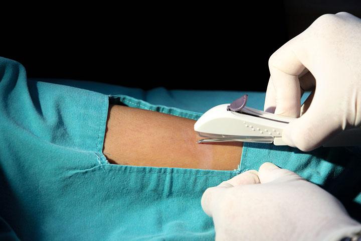 Birth Control Implant