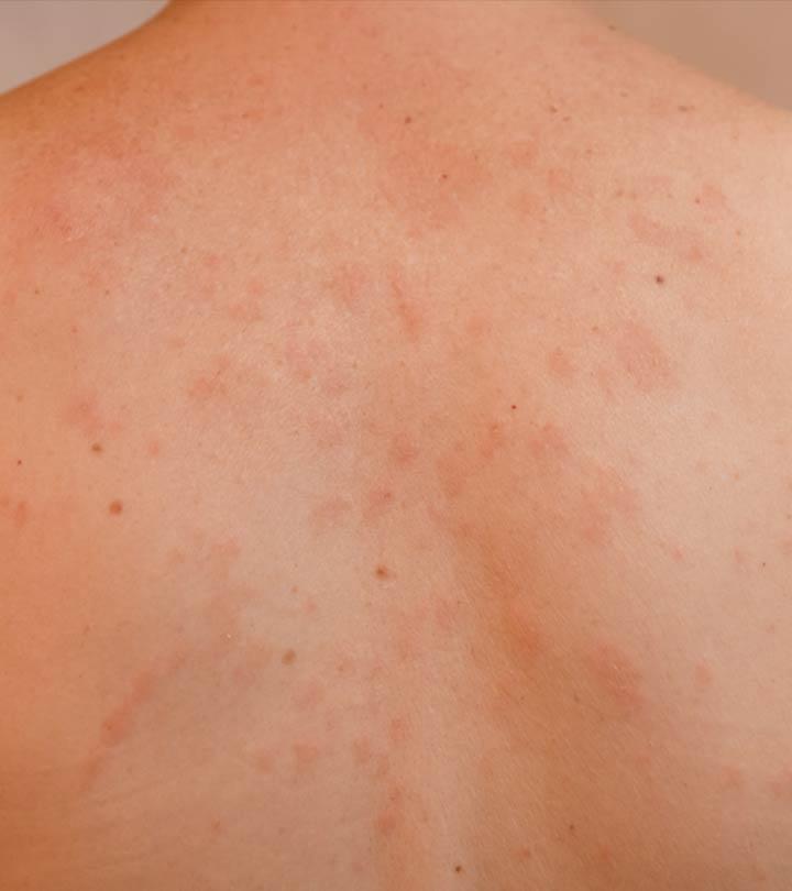 Symptoms Of Pityriasis Rosea In Children