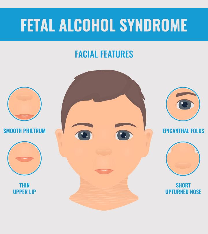 Child With Fetal Alcohol Syndrome