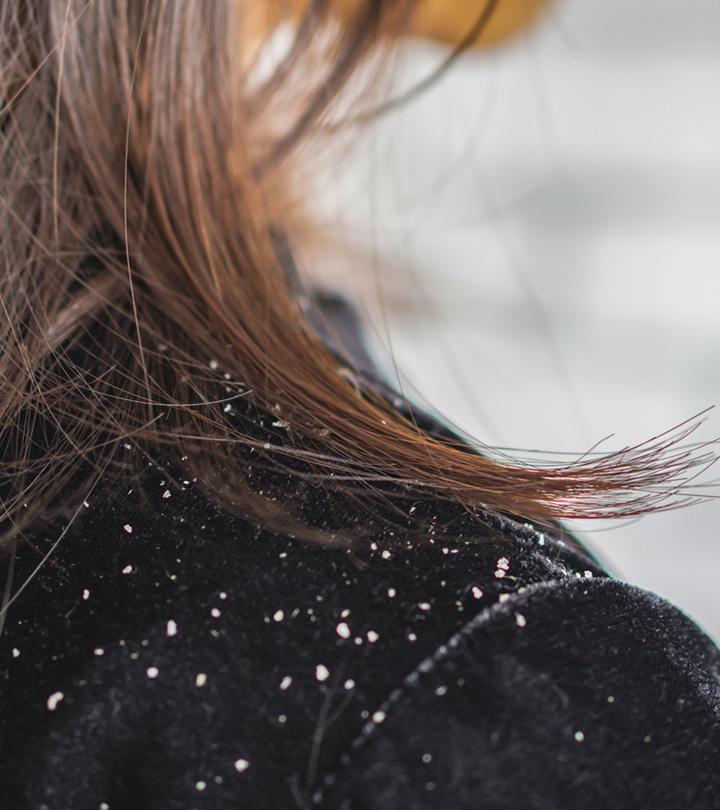 Dandruff During Pregnancy: Causes, Treatment And Home Remedies