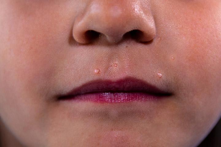 Warts On Kids: Are They Contagious, Their Causes, Treatment