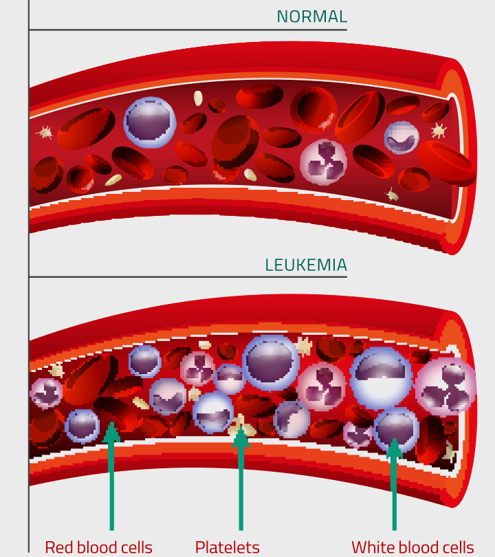 9 Symptoms Of Leukemia In Teens, Causes, Diagnosis & Treatment