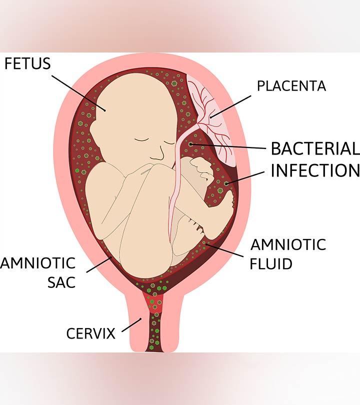 Chorioamnionitis: Causes, Symptoms, Diagnosis And Treatment