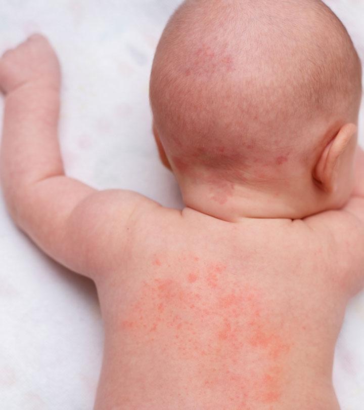 Baby Heat Rash: Types, Symptoms And Treatment