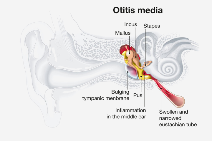 Middle ear infection in babies
