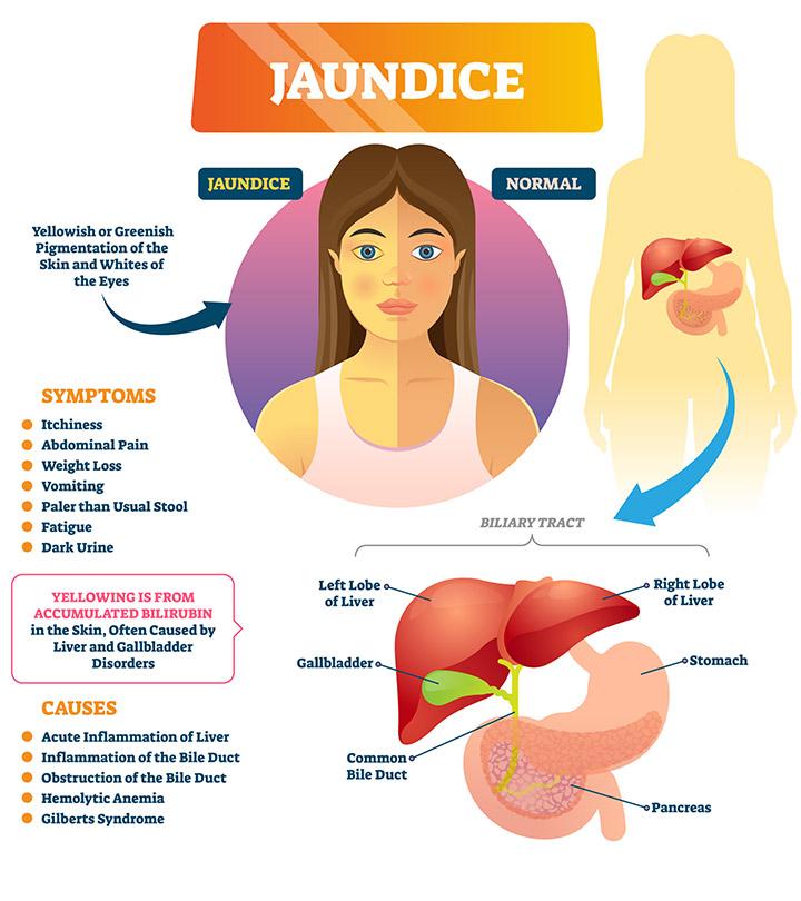 Jaundice symptoms