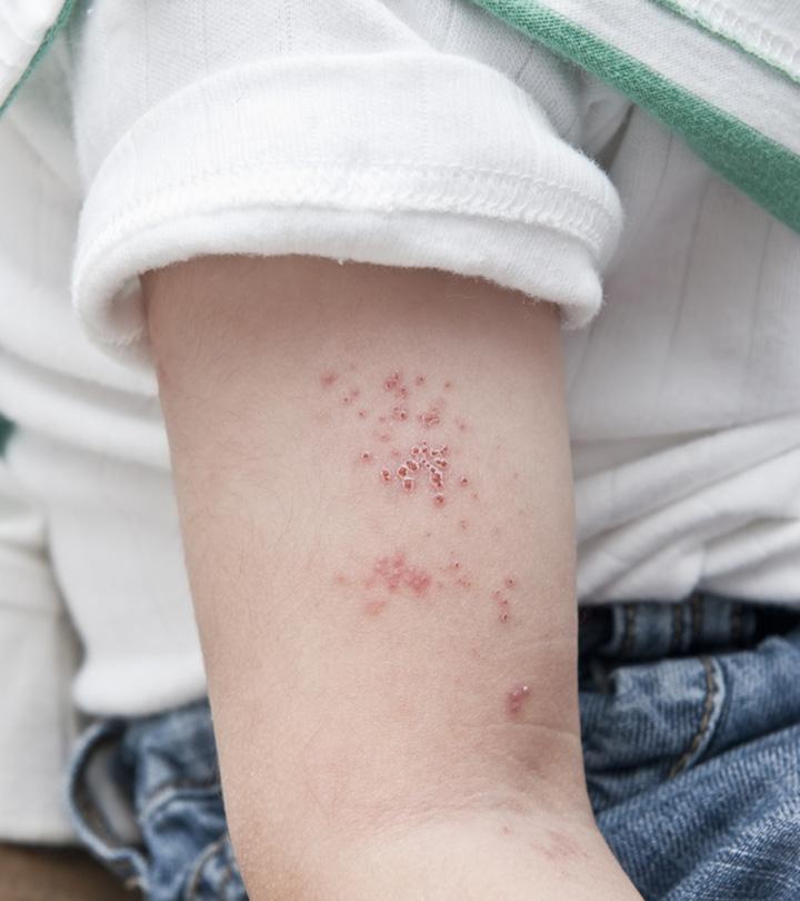 A Kid Suffering From Shingles