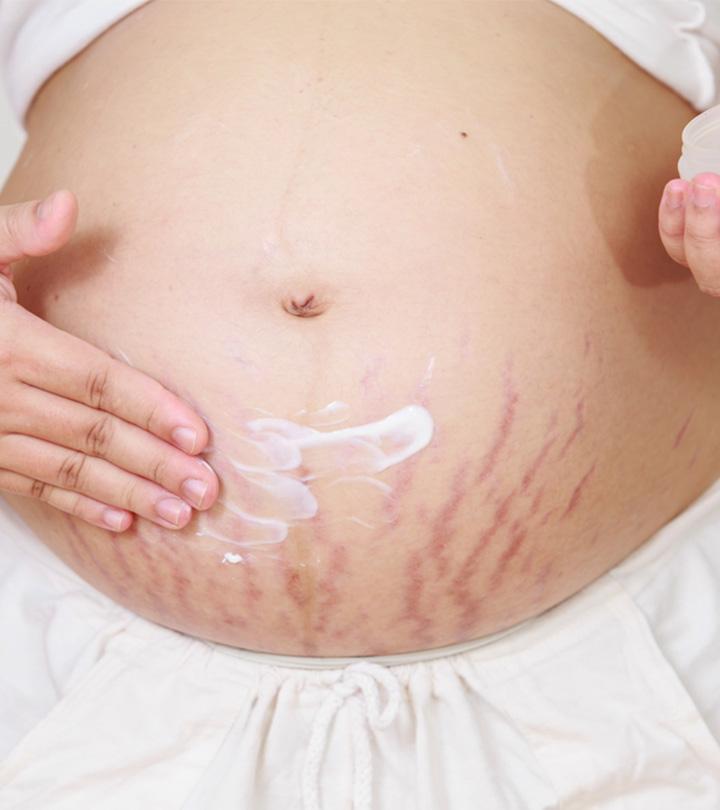 5 Effective Tips To Prevent Stretch Marks During Pregnancy