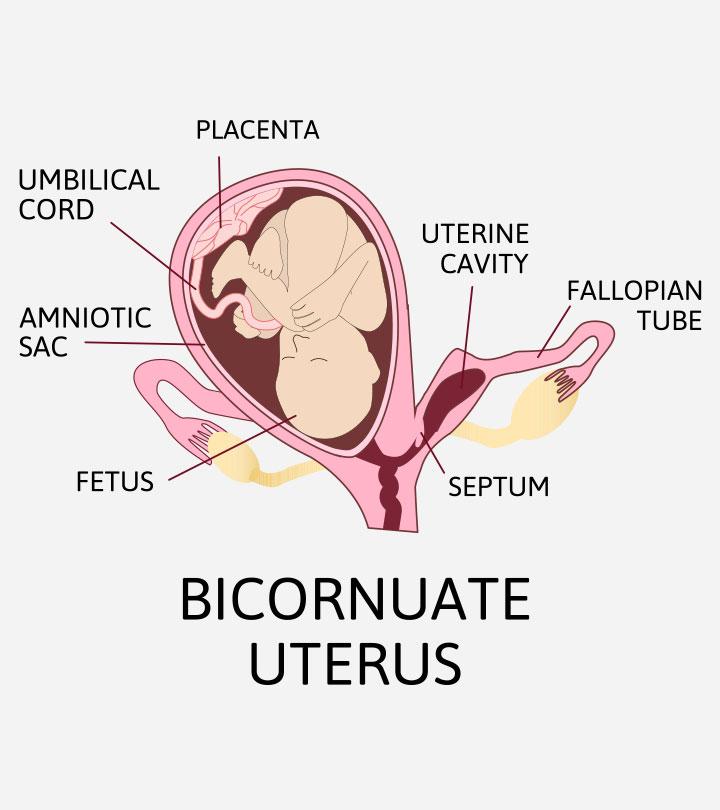 Bicornuate Uterus: Symptoms, Causes, Diagnosis, And Treatment