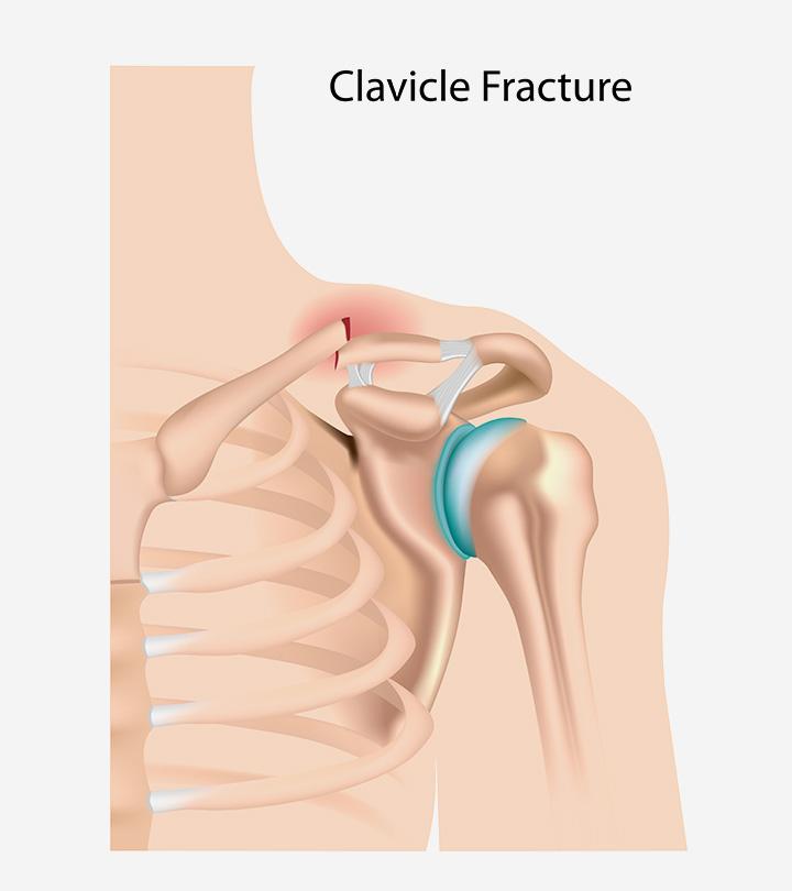 Broken Collarbone In A Child