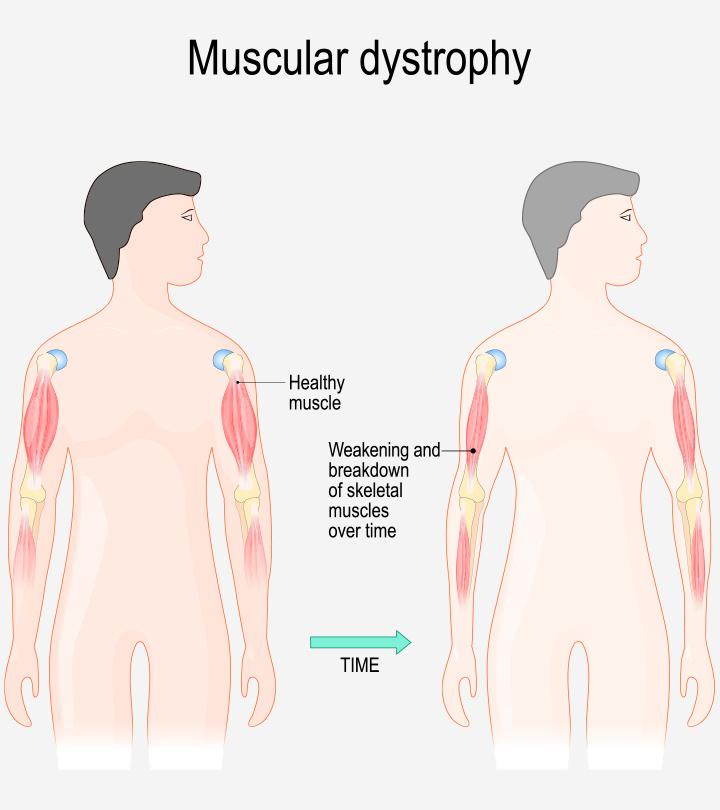 Muscular dystrophy diagram