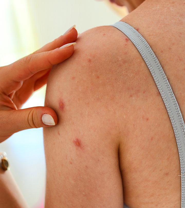A Pregnant Woman Suffering From Rubella