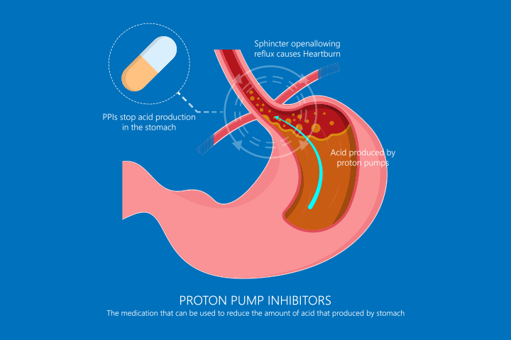 Proton pump inhibitors can help treat heartburn