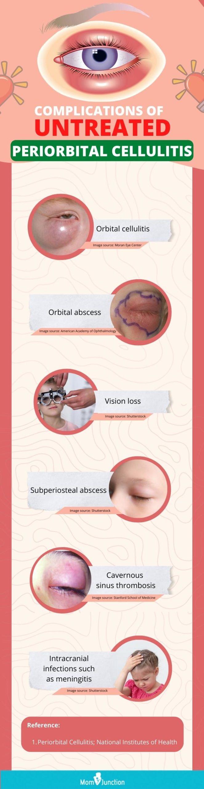 periorbital cellulitis contagious