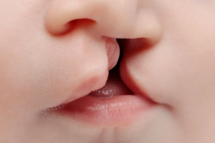 Babies with a cleft lip have difficulty in chewing