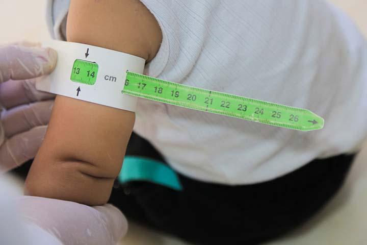 Babies with bloody stools due to digestive issues may be malnourished