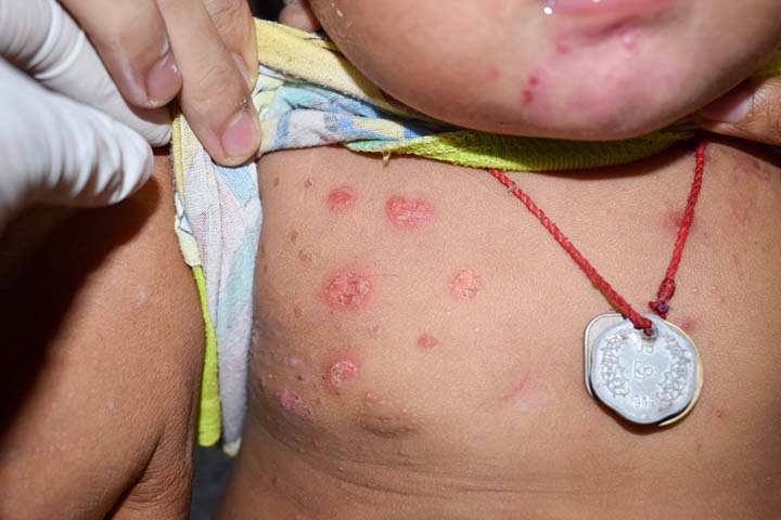 Bullous impetigo appear as pink to red-colored lesions on the skin