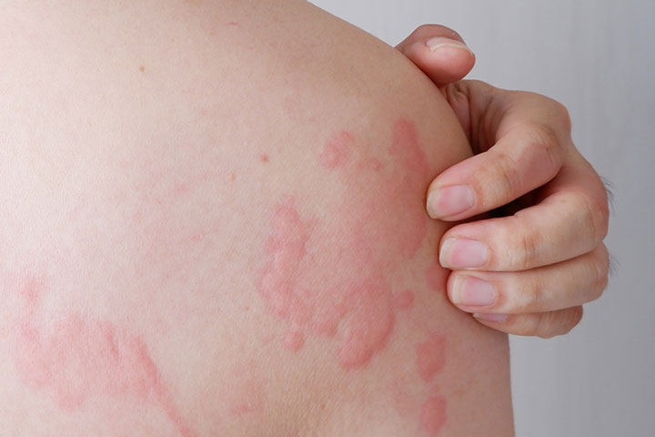 Postpartum Hives: Causes, Symptoms, Treatment And Remedies