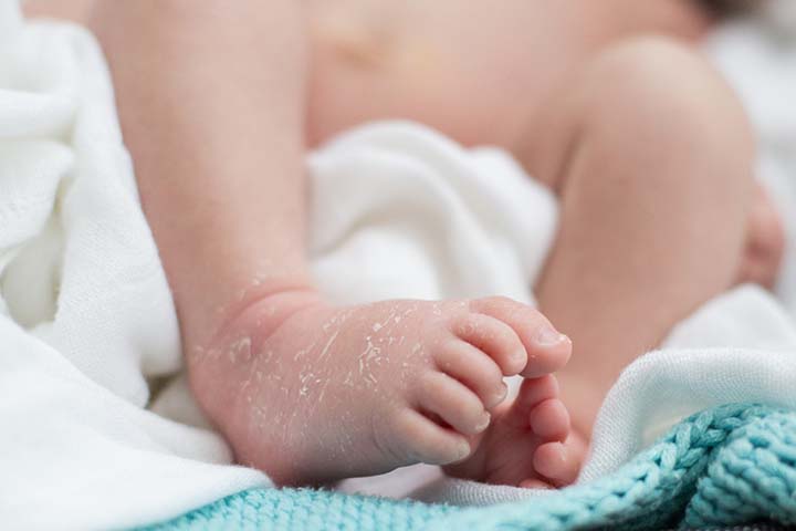 Baby Heat Rash: Types, Symptoms And Treatment