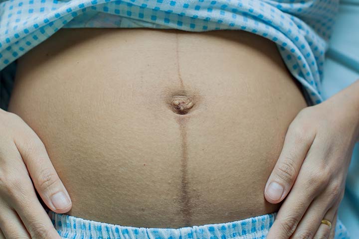 Outie Belly Button During Pregnancy – Everything You Need To Know