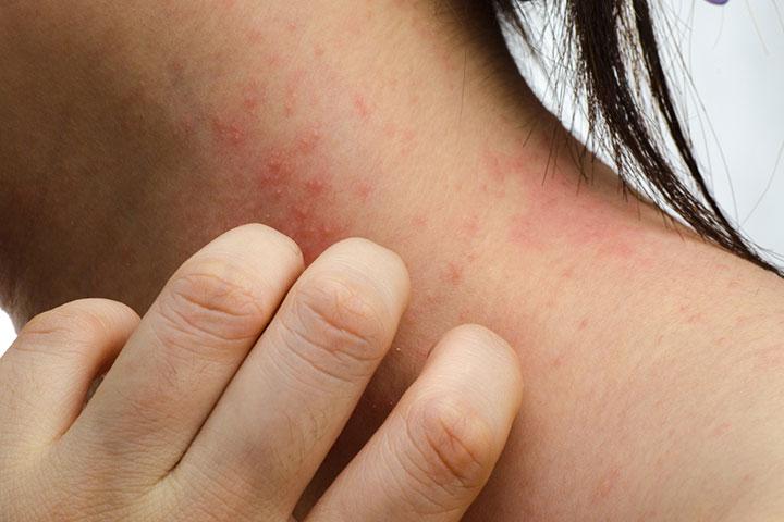 Rash Under Breast: Causes, Treatment, and Prevention