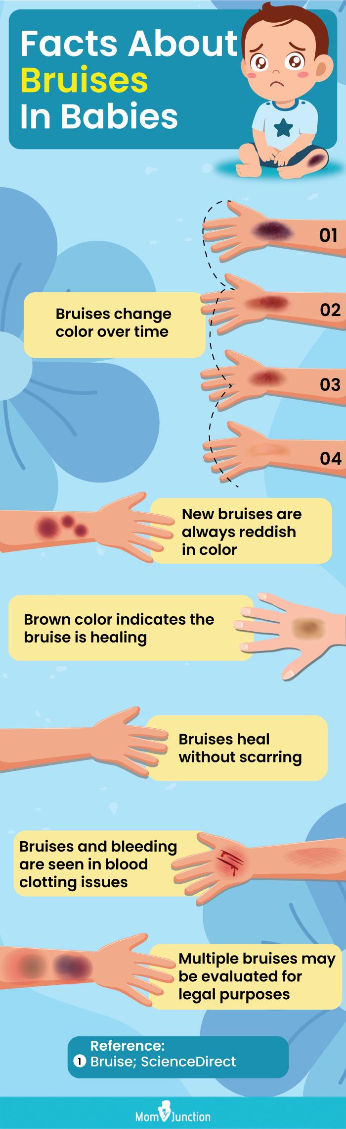 Leukemia bruising in children