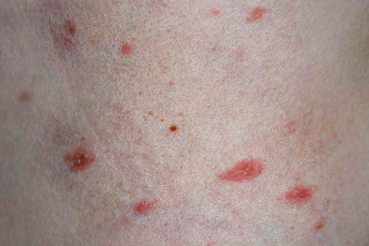 Pityriasis Rosea In Children: Symptoms, Causes And, 47% OFF
