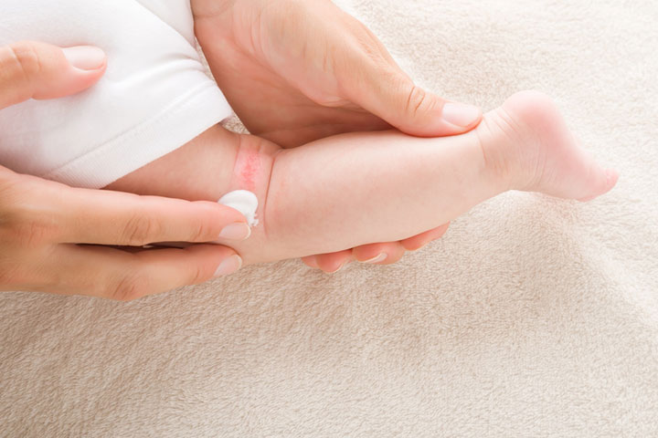 Udtømning indsats Sindssyge 7 Causes Of Dry Skin On Baby, Symptoms, And Home Remedies