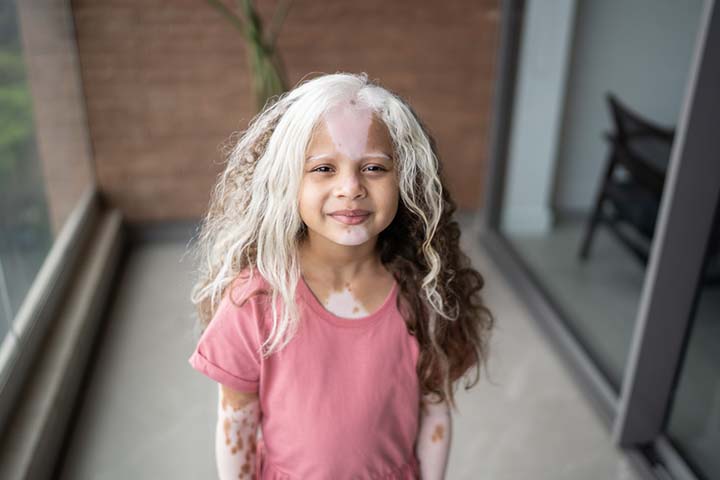 Universal vitiligo in children 