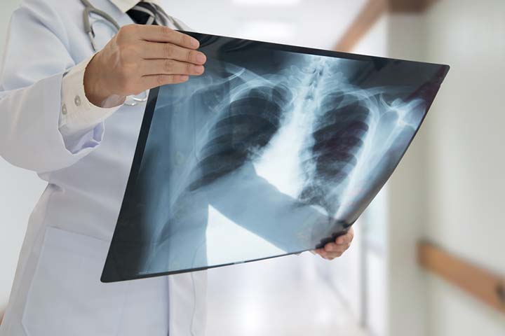 X-rays can help diagnose chest pain in teenagers