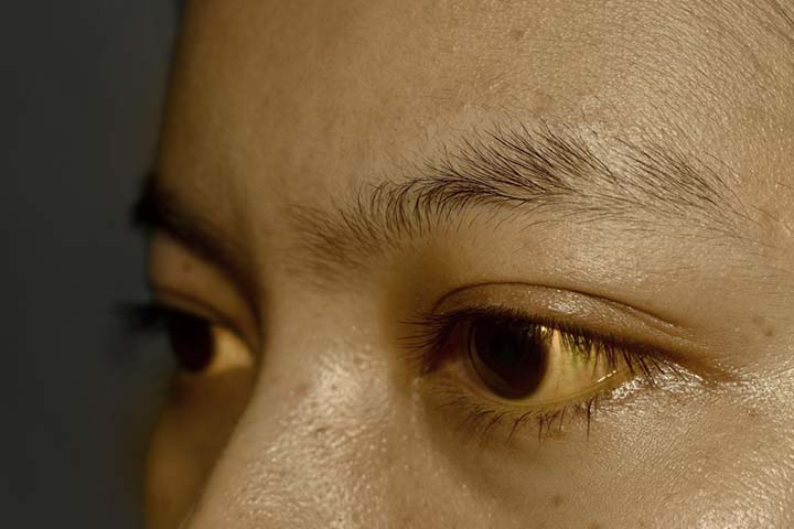 Yellow discoloration of the skin and the sclera is a sign of jaundice