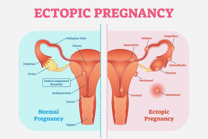 An ectopic pregnancy may give a false negative report