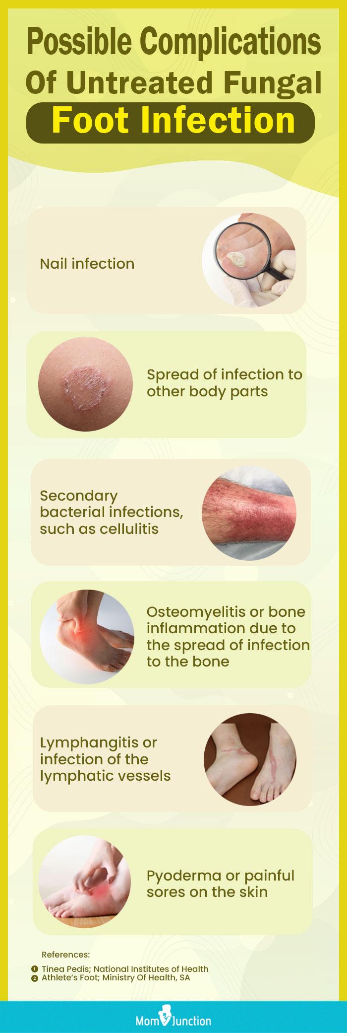 Fungal nail infection? - Excilor Solution